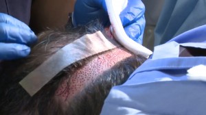 Donor area immediately after FUE's have been extracted.